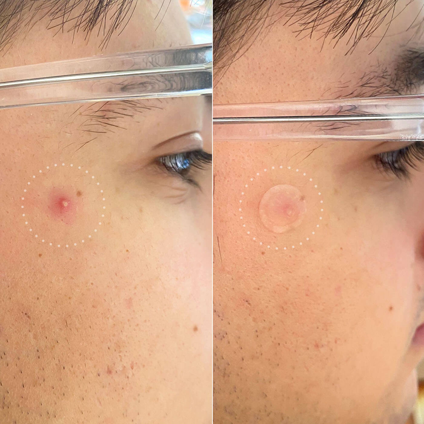 Pimple Patch Invisible+ Spot Patches - 39 stuks