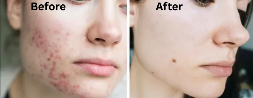 Best Sunscreen for Pimple Prone Skin: A Complete Guide 2 Dealing with a Blood Filled Pimple